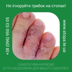 Мікоз. Причини та лікування