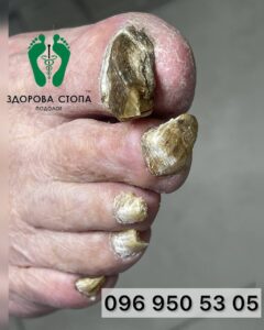 Лікування грибка в Тернополі