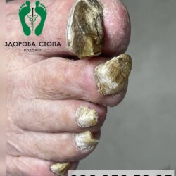 Лікування грибка в Тернополі