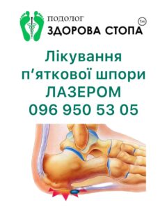 Лікування п'яткової шпори лазером