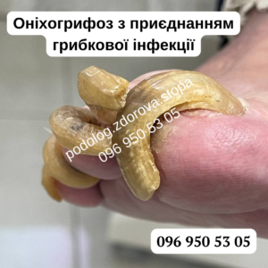 Причини оніфогрифозу