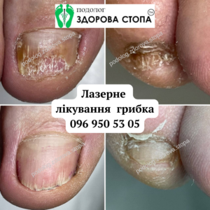 Комплексне лікування грибка