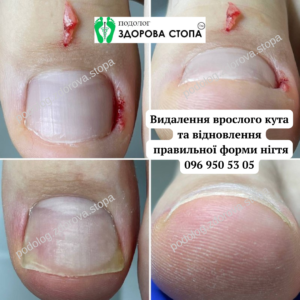 Врослий кут