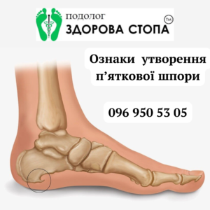Ознаки утворення п'яткової шпори