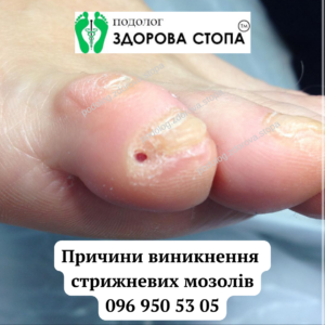 Причини виникнення стрижневих мозолів