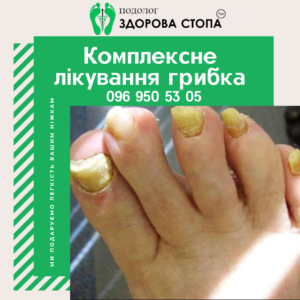 Причини виникнення мікозу