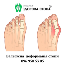 Вальгусна деформація стопи