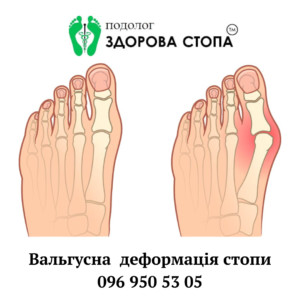 Вальгусна деформація стопи