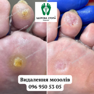 Видалення мозолів