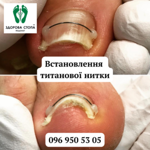 Титанова нитка