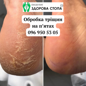 Тріщини на п'ятах