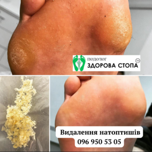 Видалення натоптишів у Тернополі