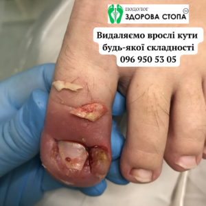 Видалення врослих кутів