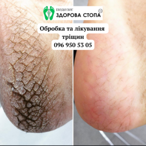 Тріщини на п'ятах