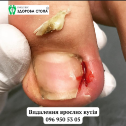 Видалення врослих кутів