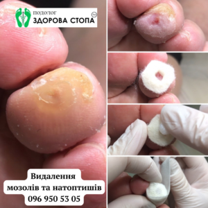 Мозолі та натоптиші