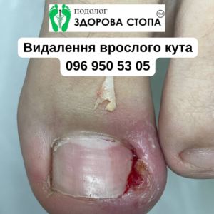Видалення врослого кута