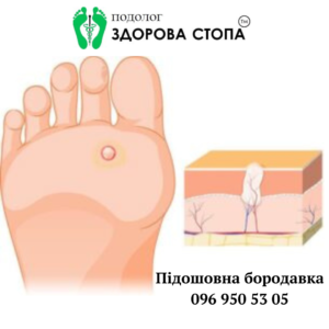 Видалення бородавок