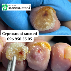 Стрижневий мозоль