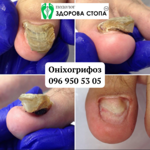Лікування оніхогрифозу