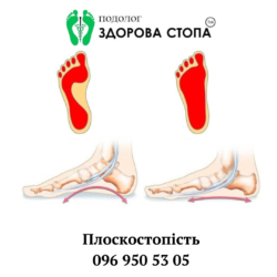 Плоскостопість