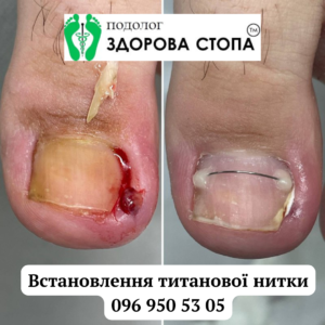 Встановлення титанової нитки