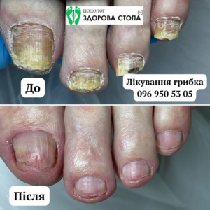 Комплексне лікування грибка