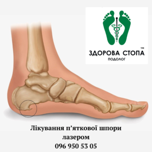 Лікування п'яткової шпори