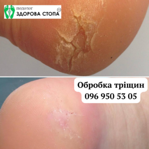 Тріщини на п'ятах