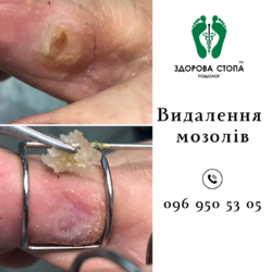 Видалення мозолів