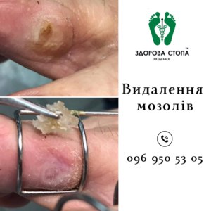 Видалення мозолів