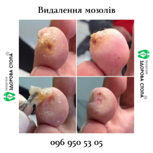 Видалення стрижневого мозоля