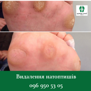 Натоптиші: чому вони з’являються і як їх позбутися?