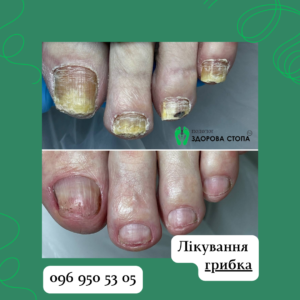 Лазерне лікування грибка