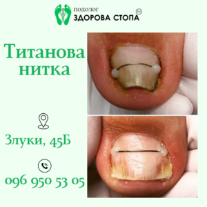Врослий ніготь. Встановлення титанової нитки