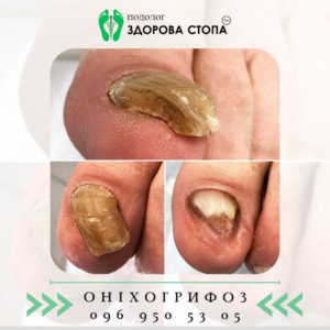 Про оніхогрифоз