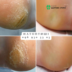 Натоптиші: причини появи, небезпеки та методи лікування