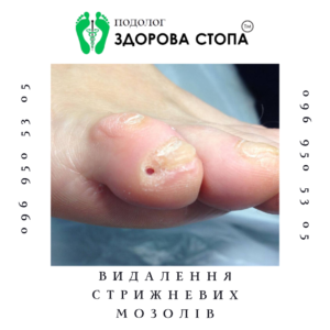Стрижневий мозоль