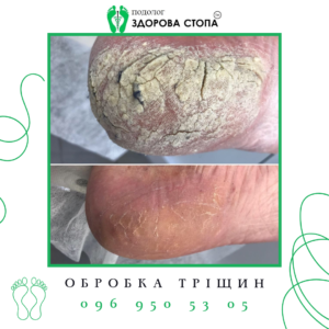 Лікування тріщин на п’ятах