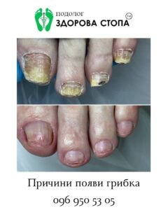 Як захистити ноги від грибка влітку?