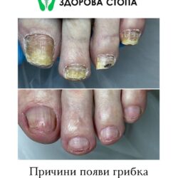 Як захистити ноги від грибка влітку?