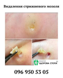 Стрижневий мозоль