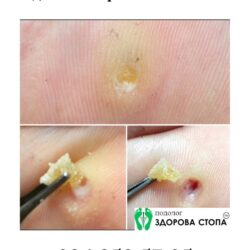 Стрижневий мозоль