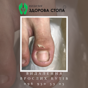 Видалення врослого кута
