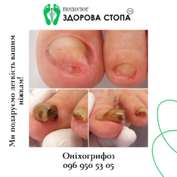 Оніхогрифоз