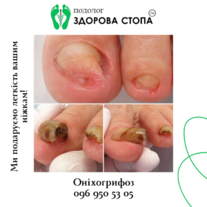 Оніхогрифоз