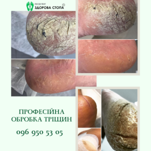 Професійна обробка тріщин