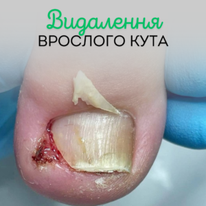 Як уникнути врослих кутів?