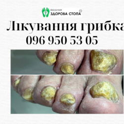 Про грибок нігтів