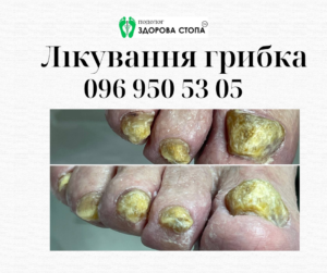 Про грибок нігтів